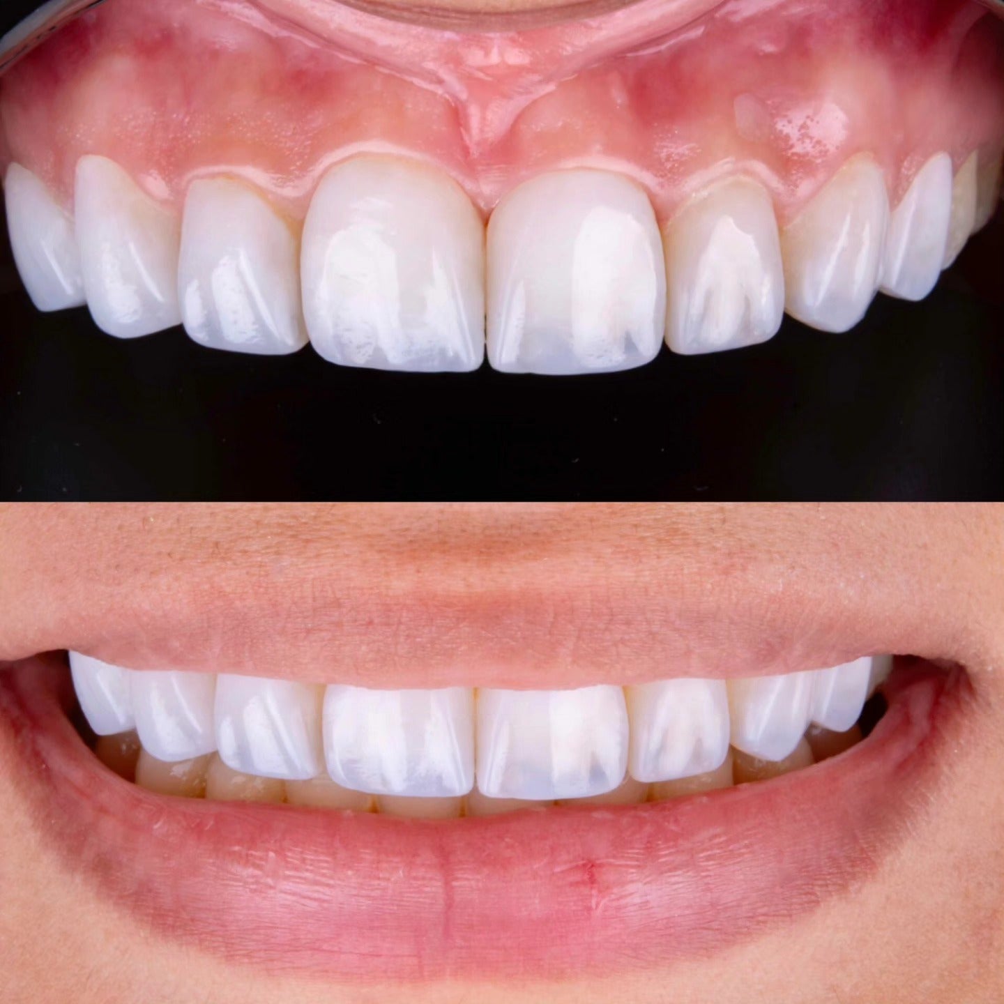 Webinar Direct Composite Veneers. Ästhetik in einer Sitzung