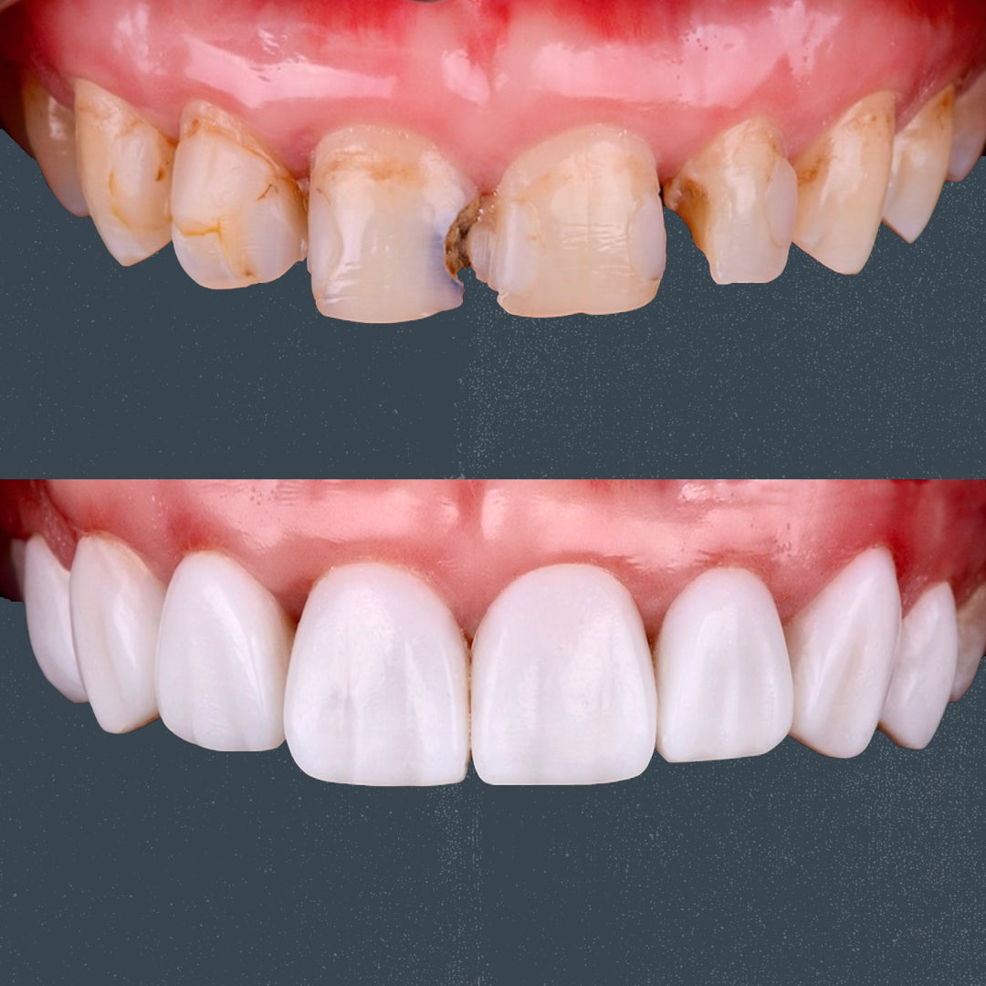 Direct Composite Veneers: Mastering the technique