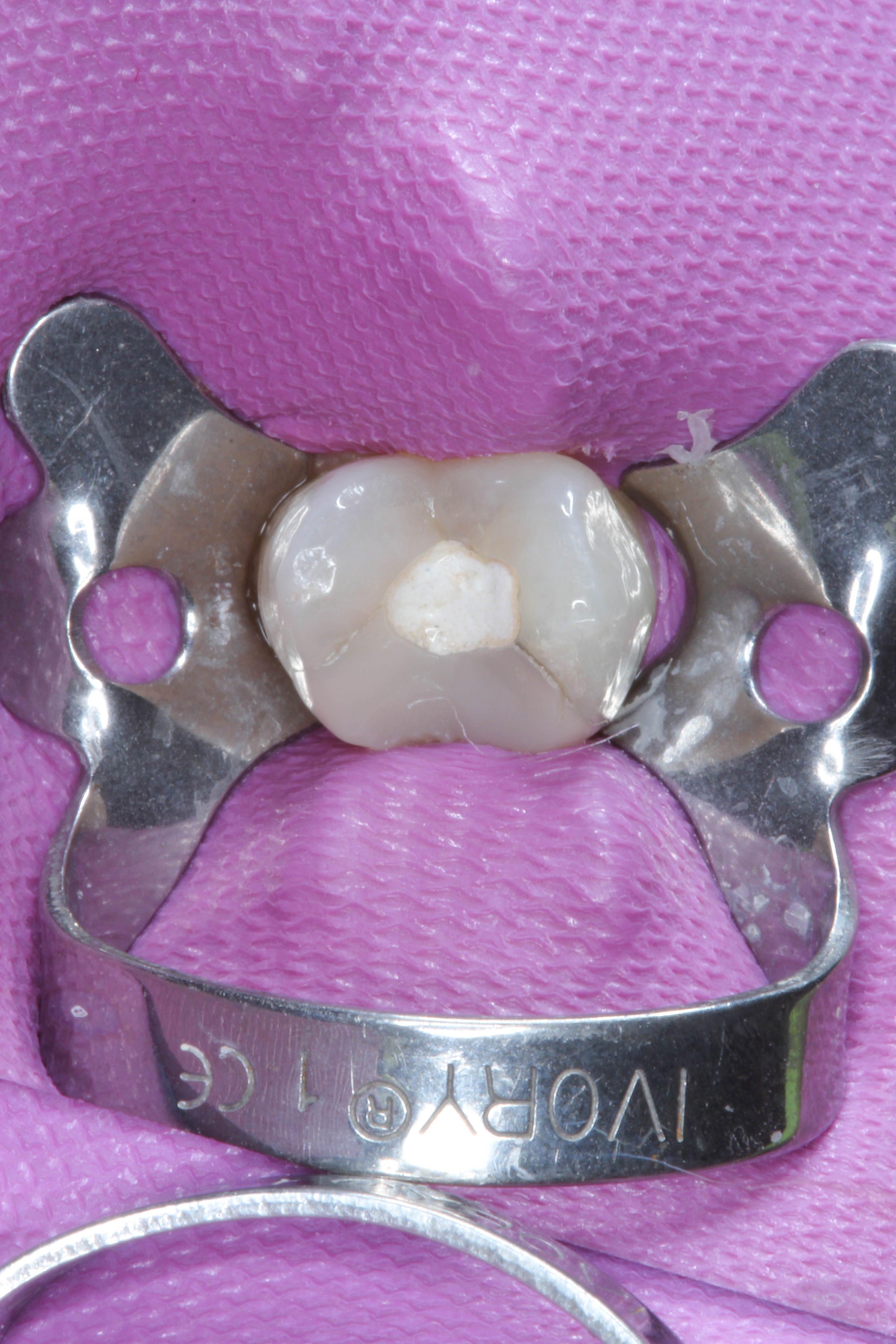 Tooth 15
