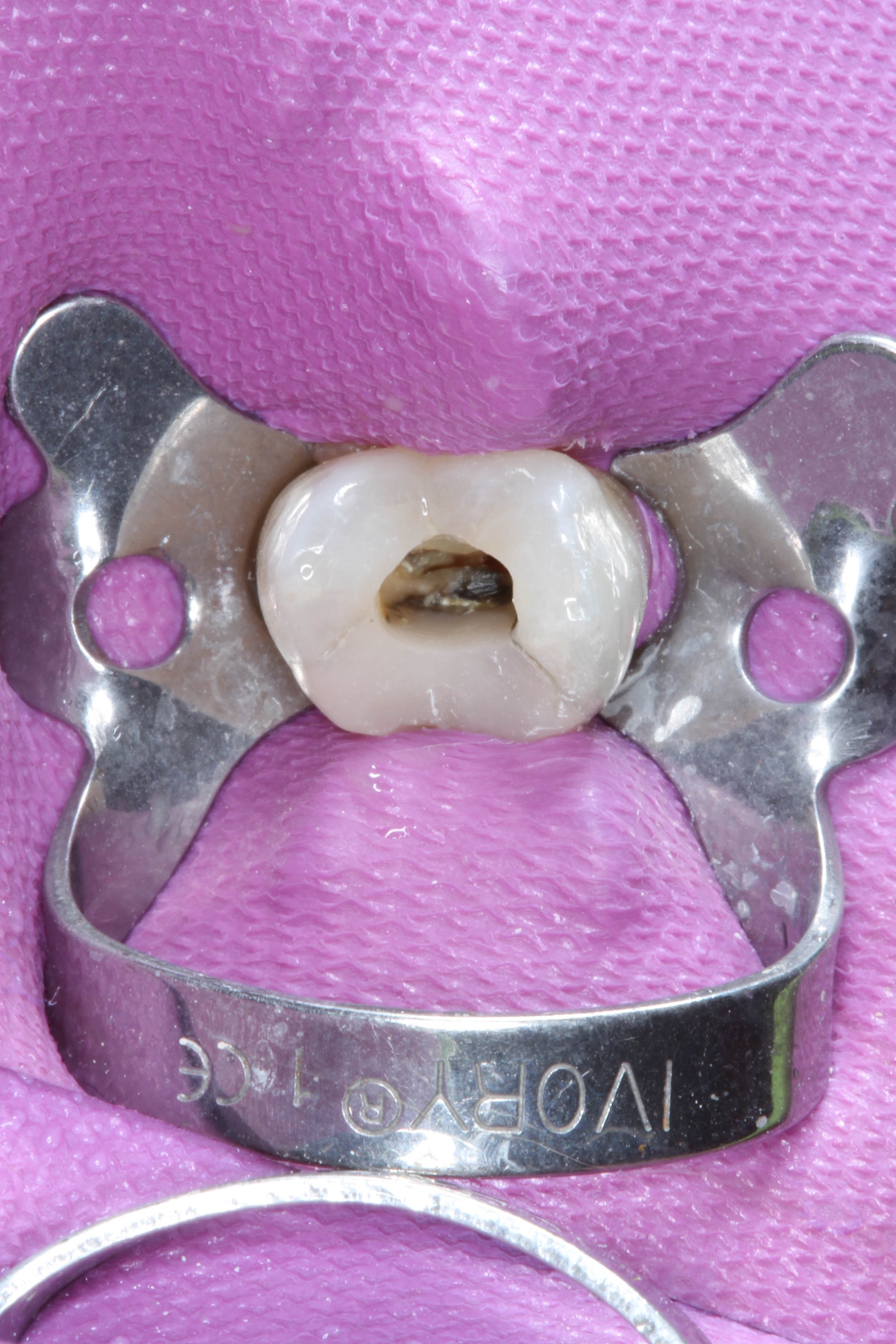 Tooth 15