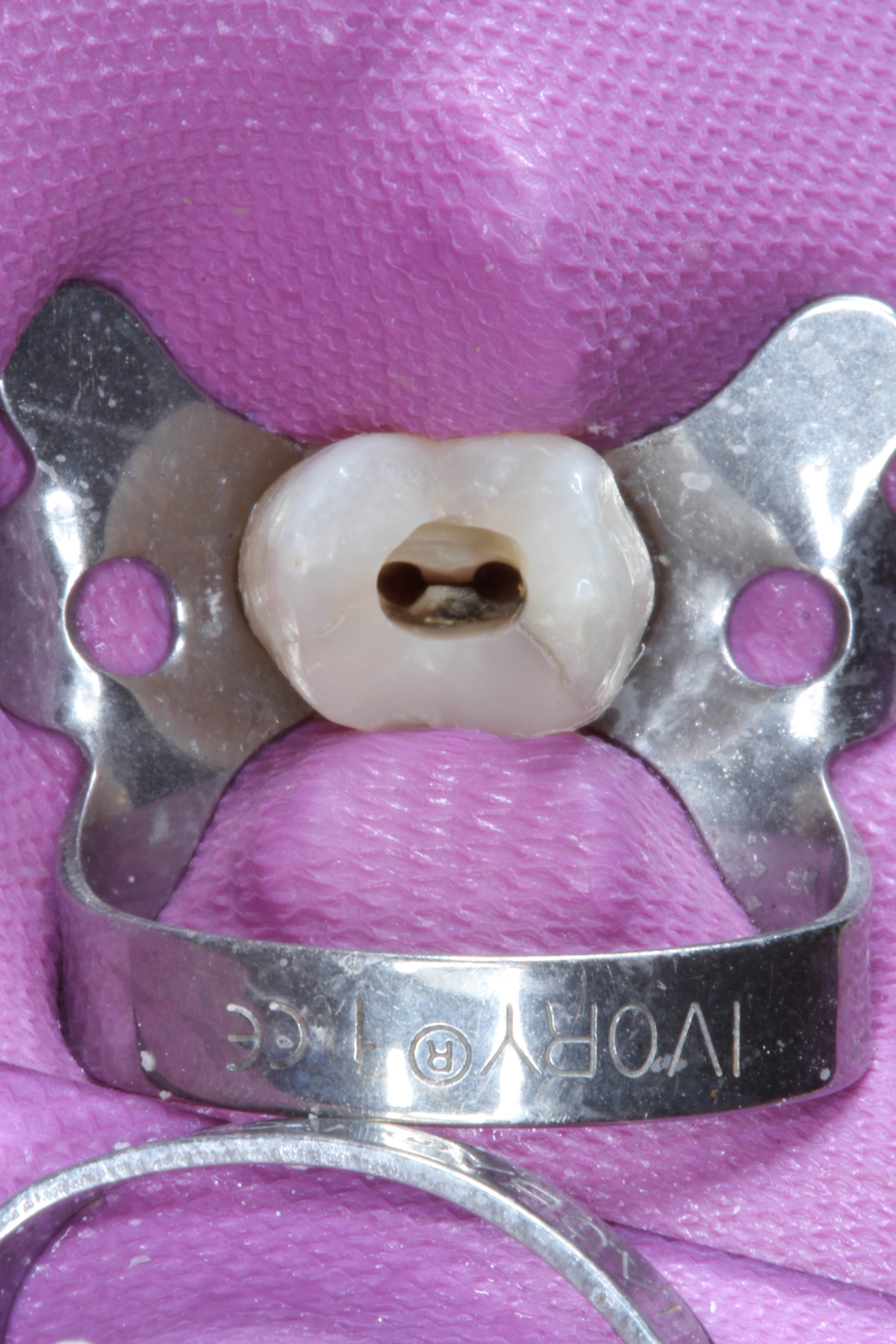 Tooth 15