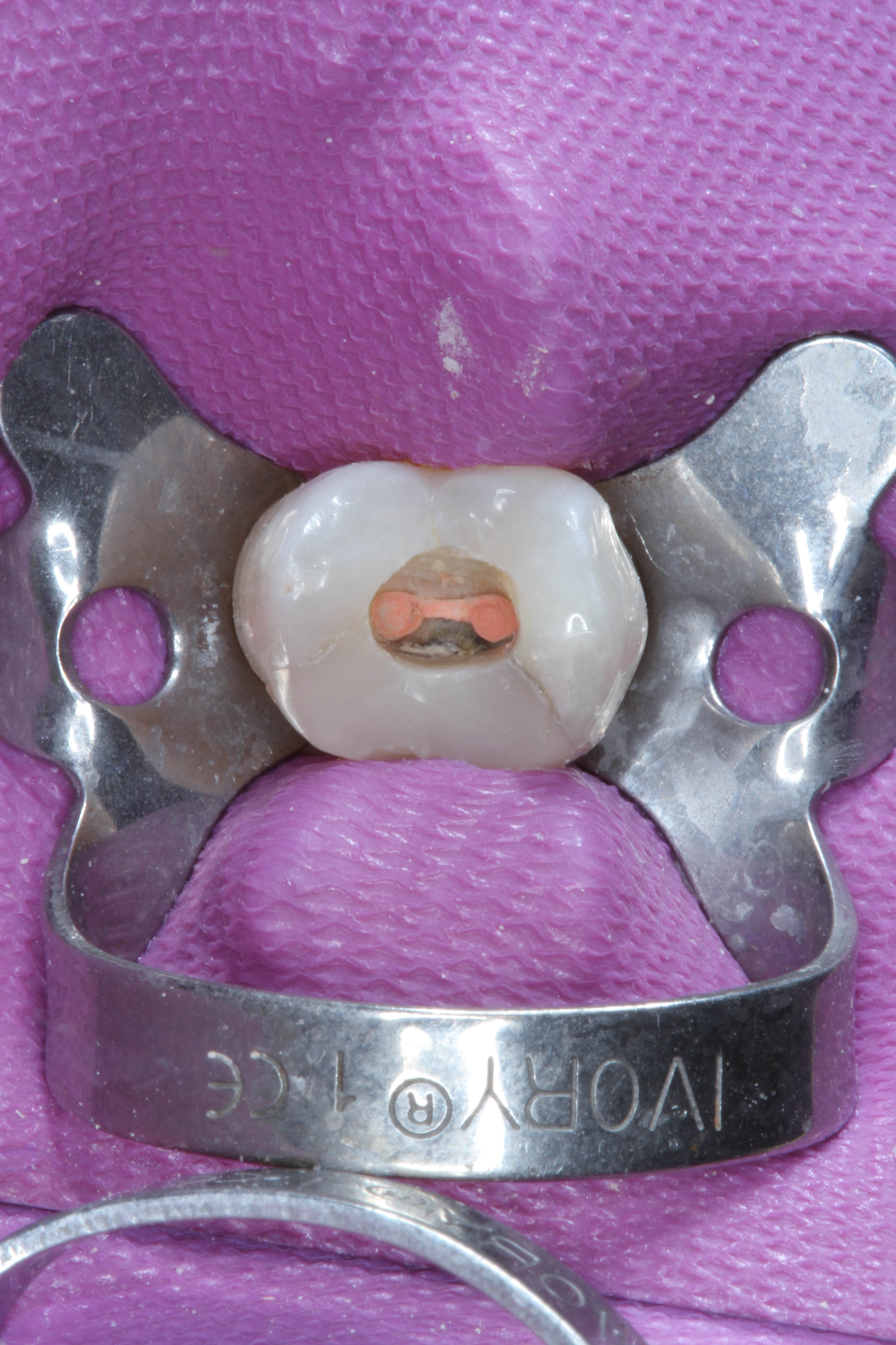 Tooth 15