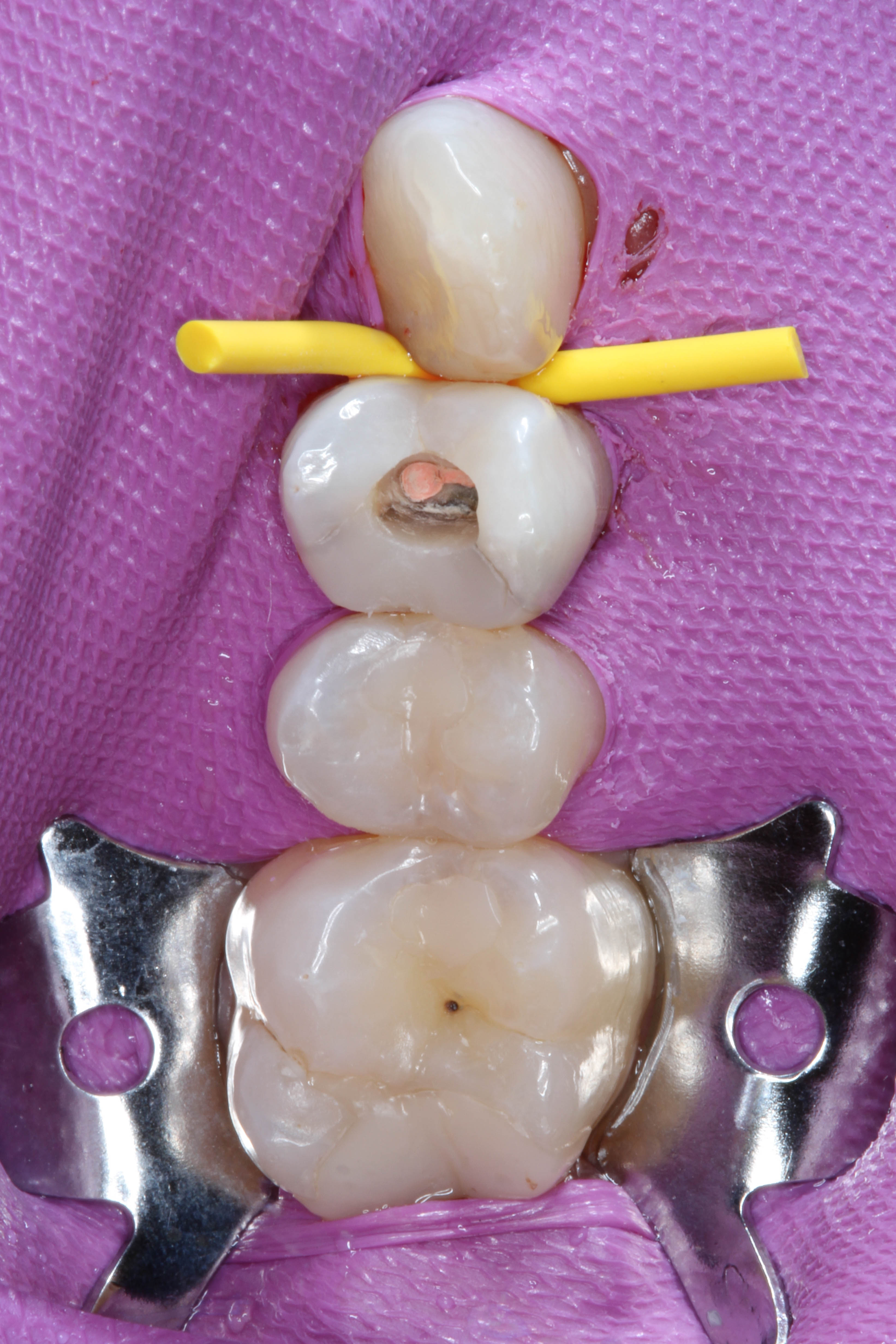 Teeth 15, 16, and 17