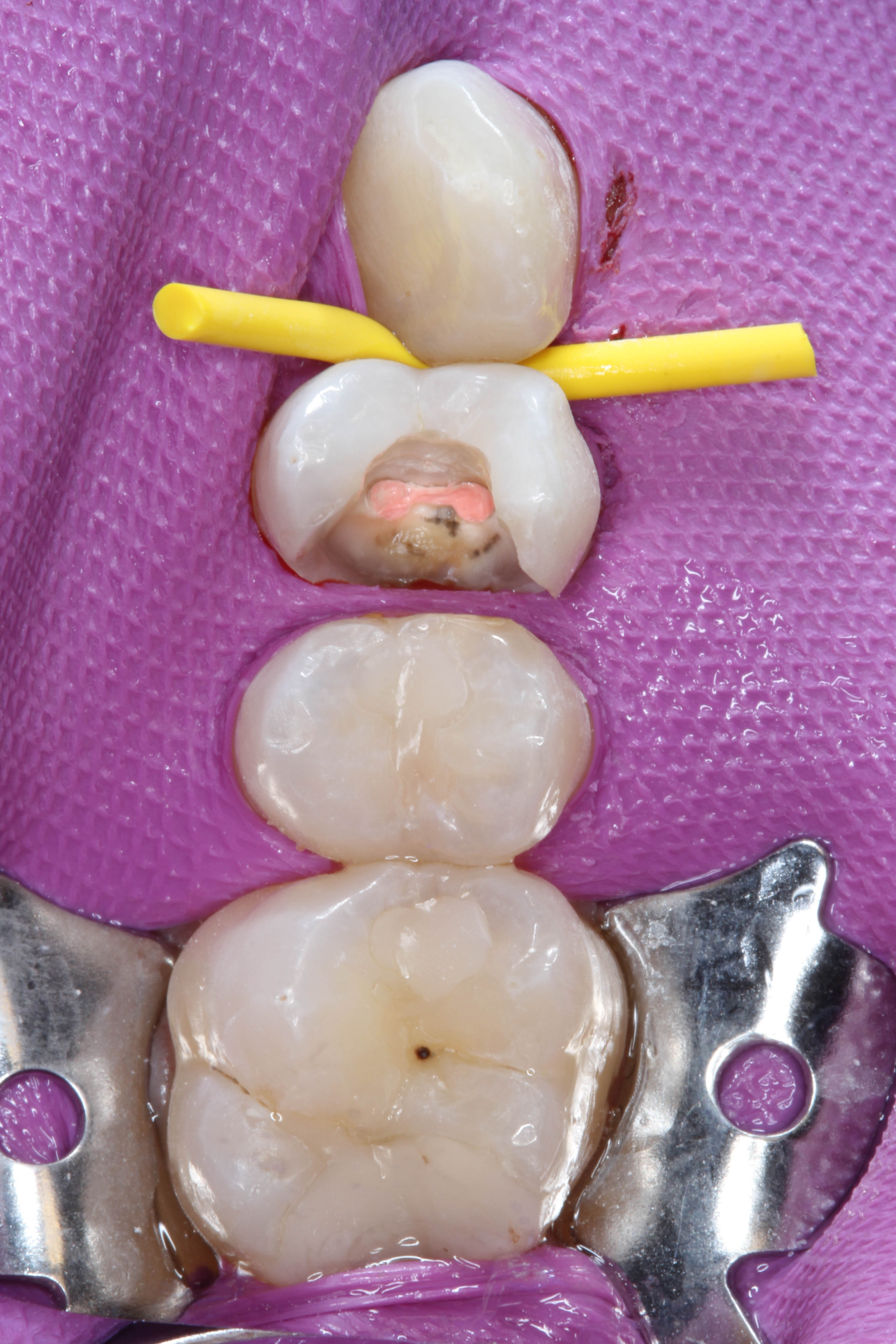 Teeth 15, 16, and 17