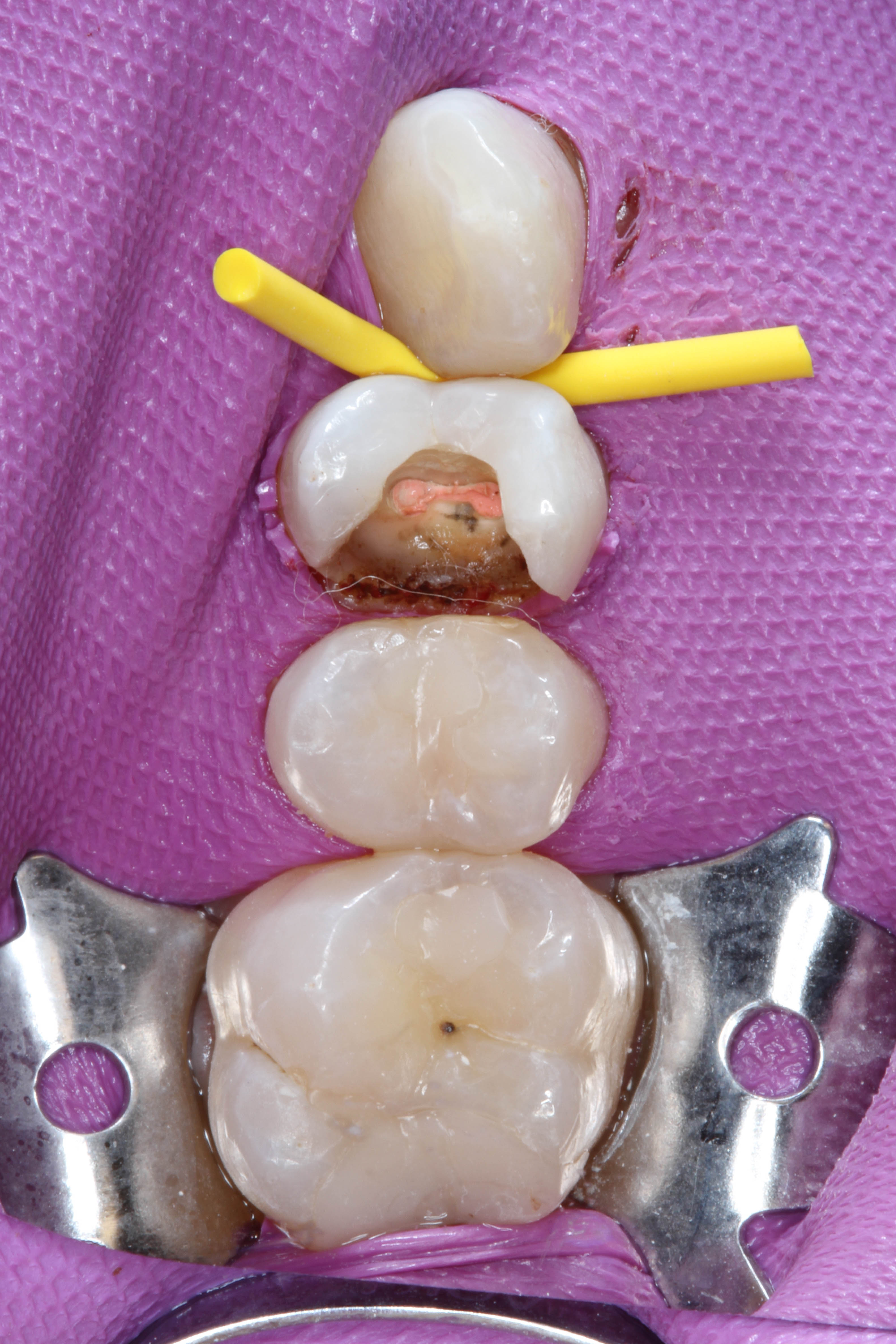 Teeth 15, 16, and 17