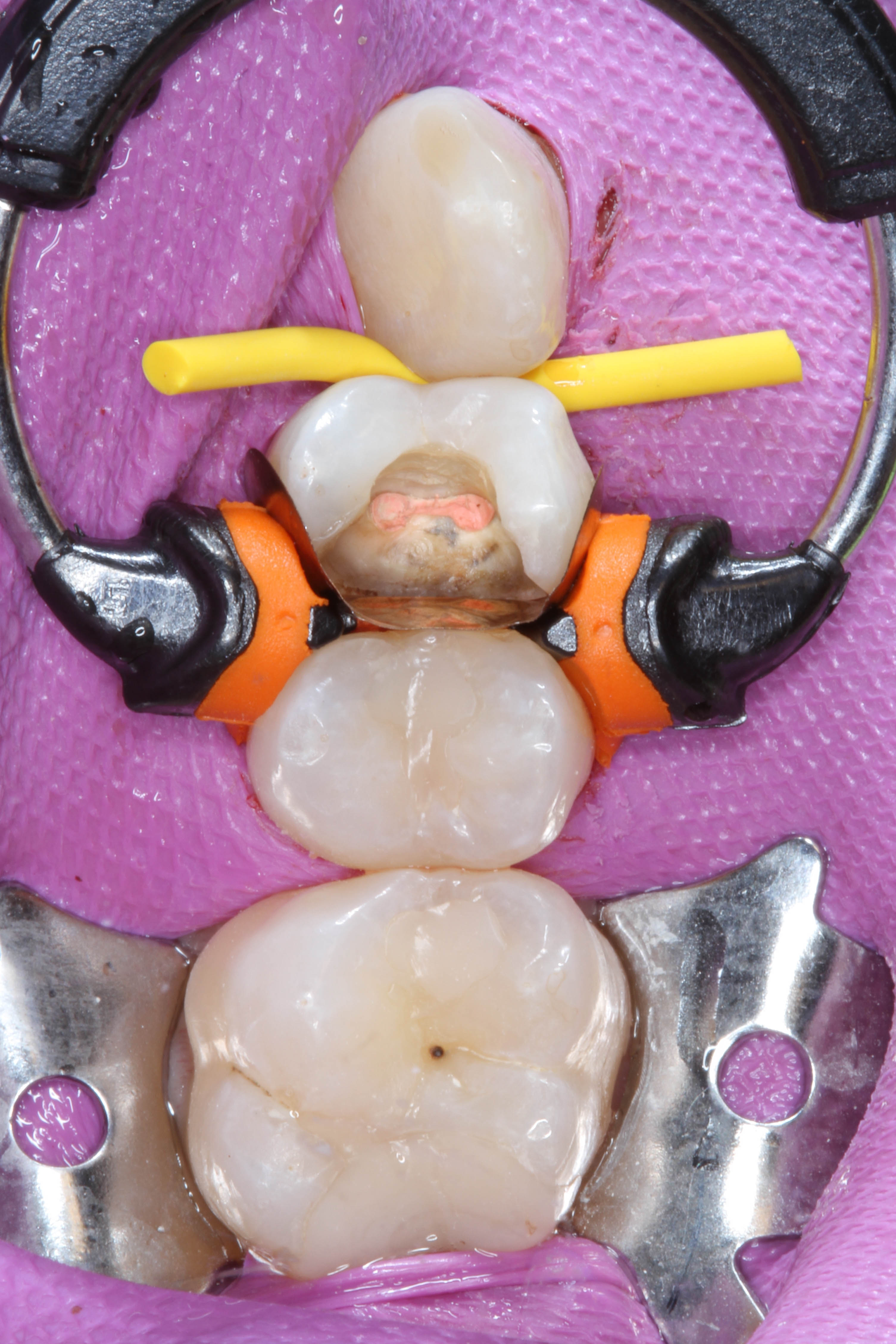 Teeth 15, 16, and 17