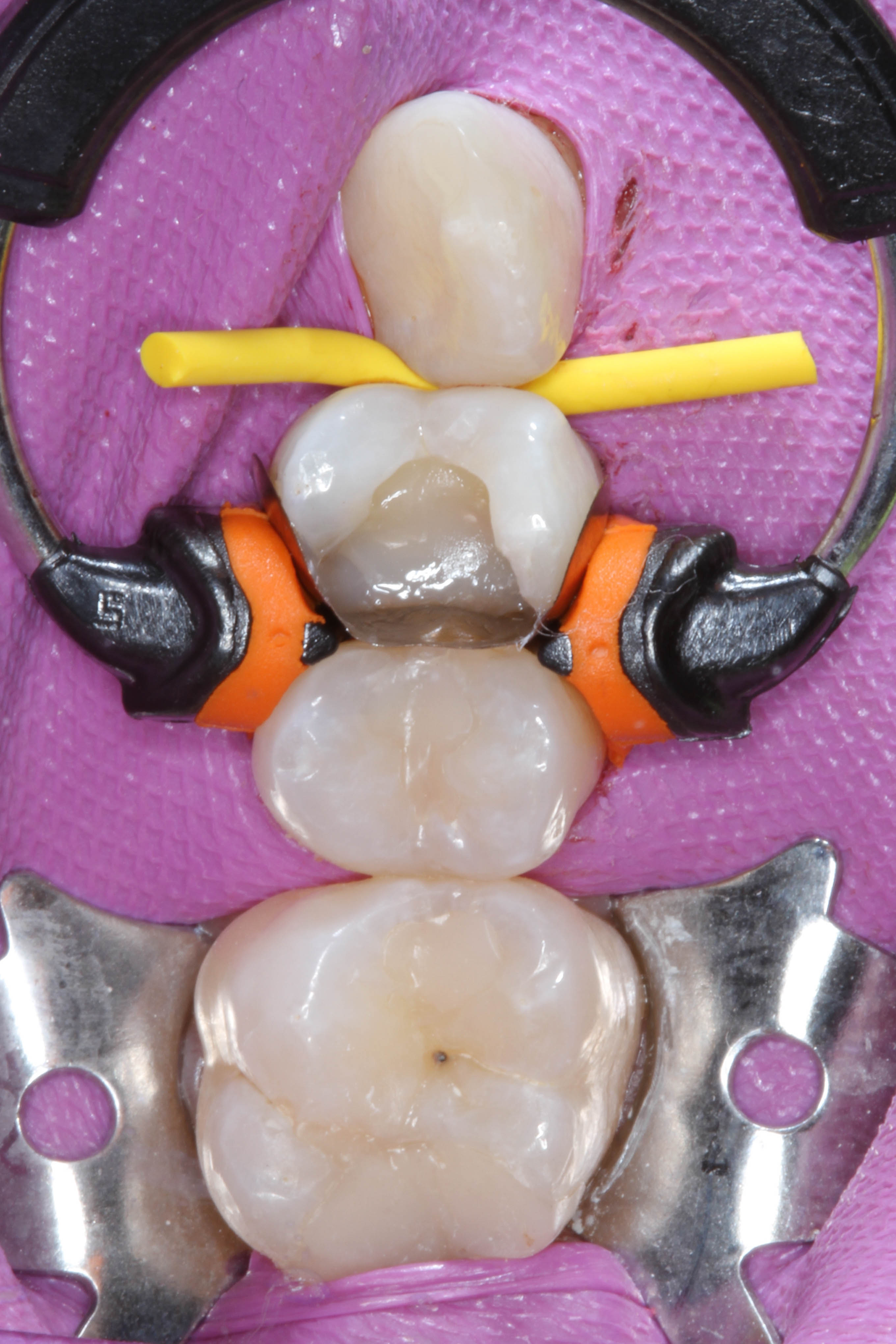 Teeth 15, 16, and 17