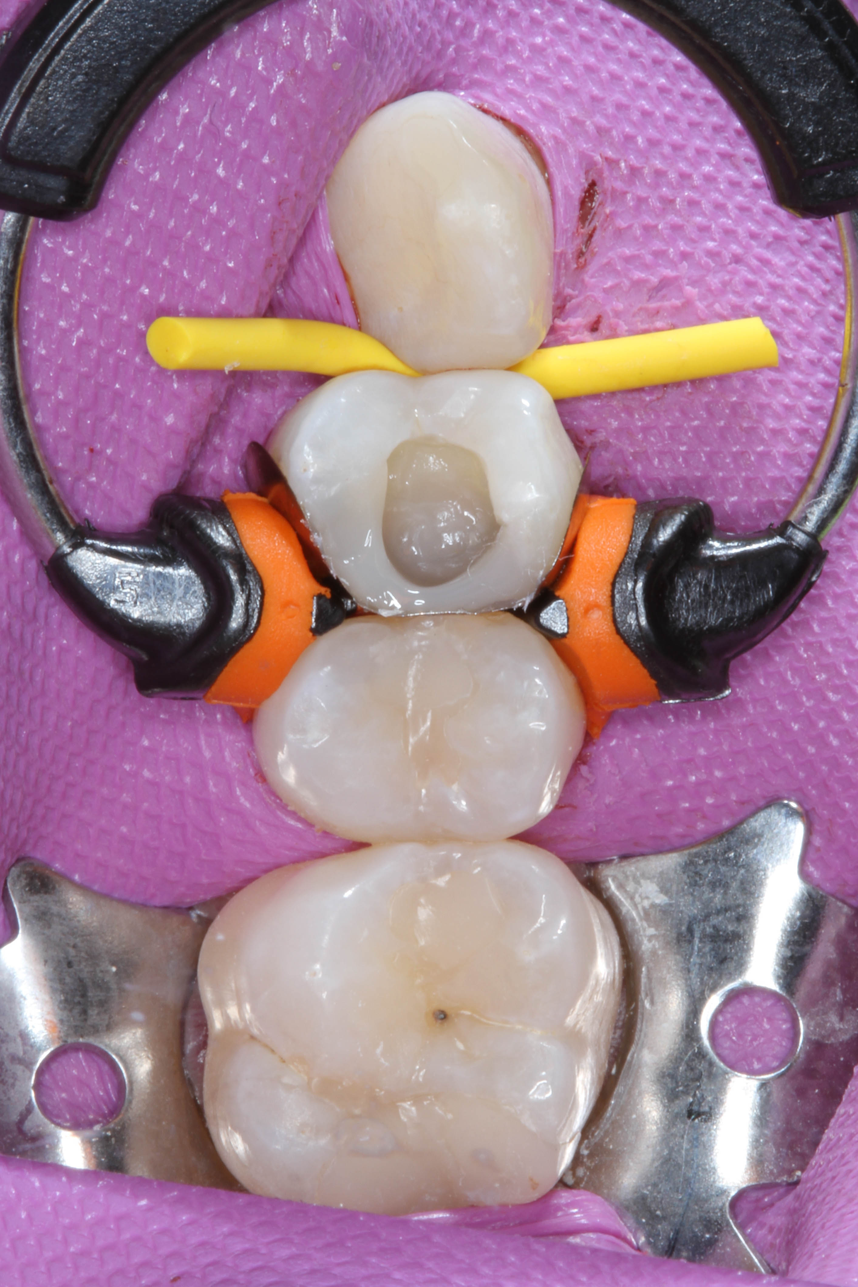 Teeth 15, 16, and 17
