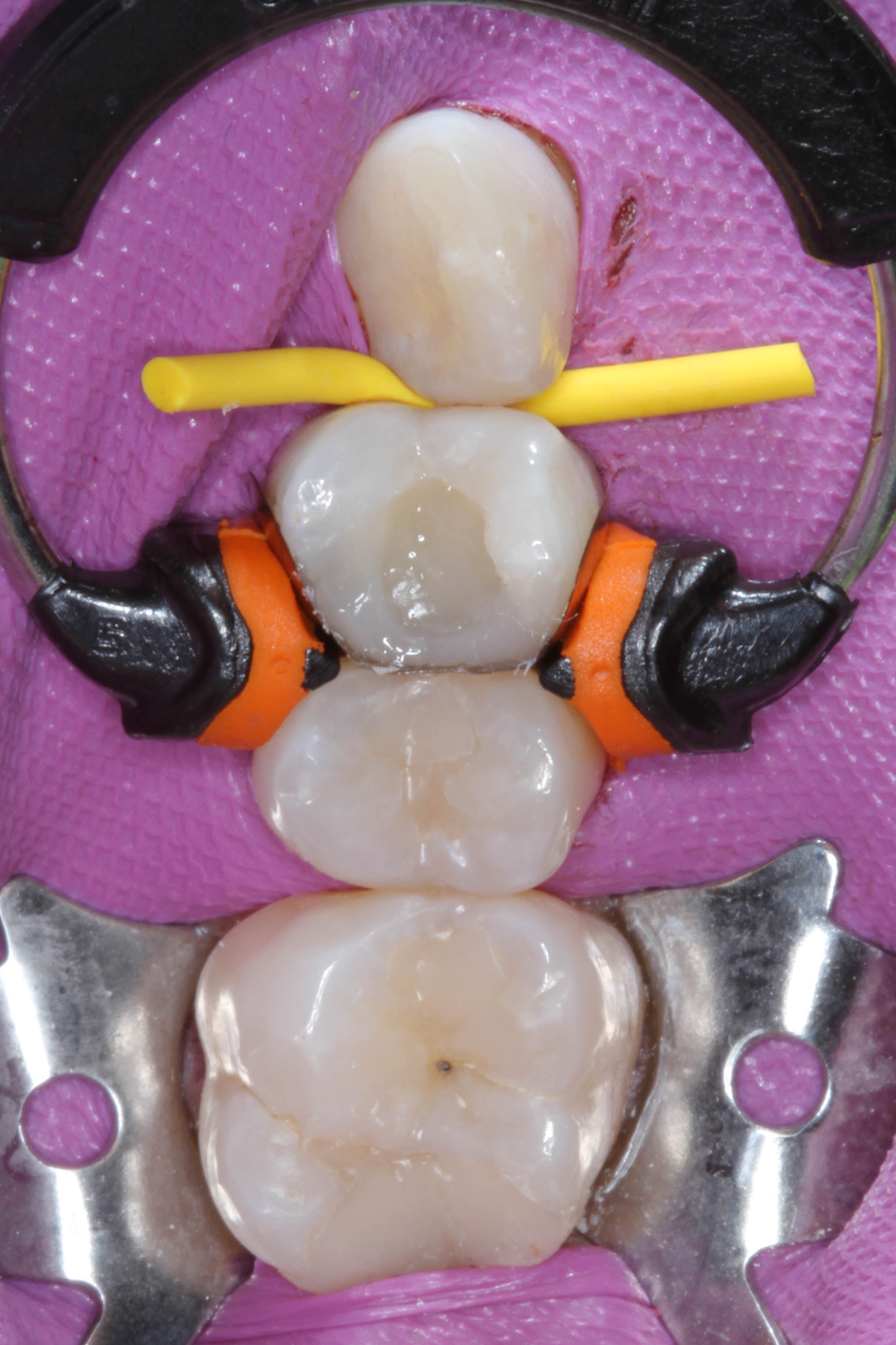 Teeth 15, 16, and 17
