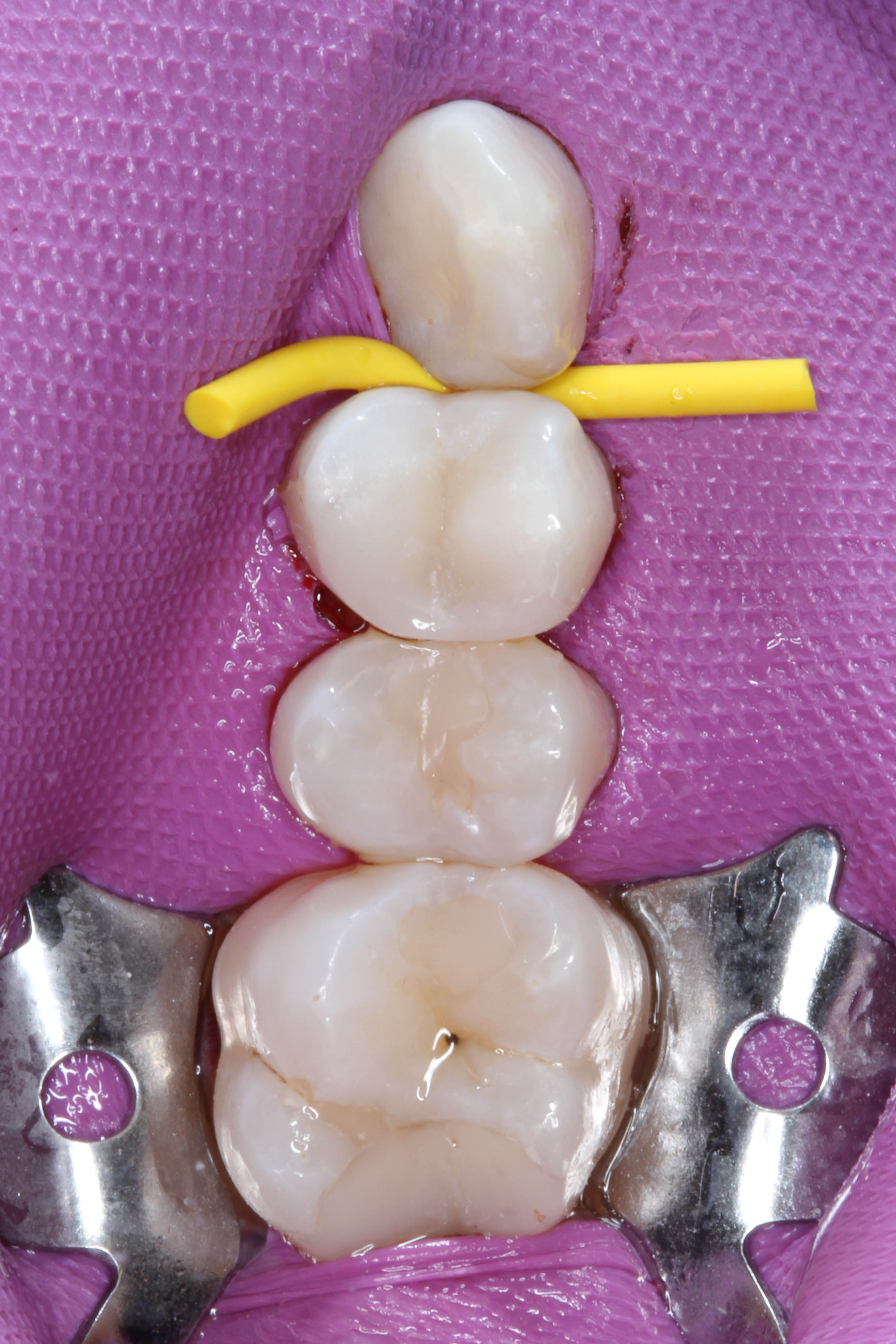 Teeth 15, 16, and 17