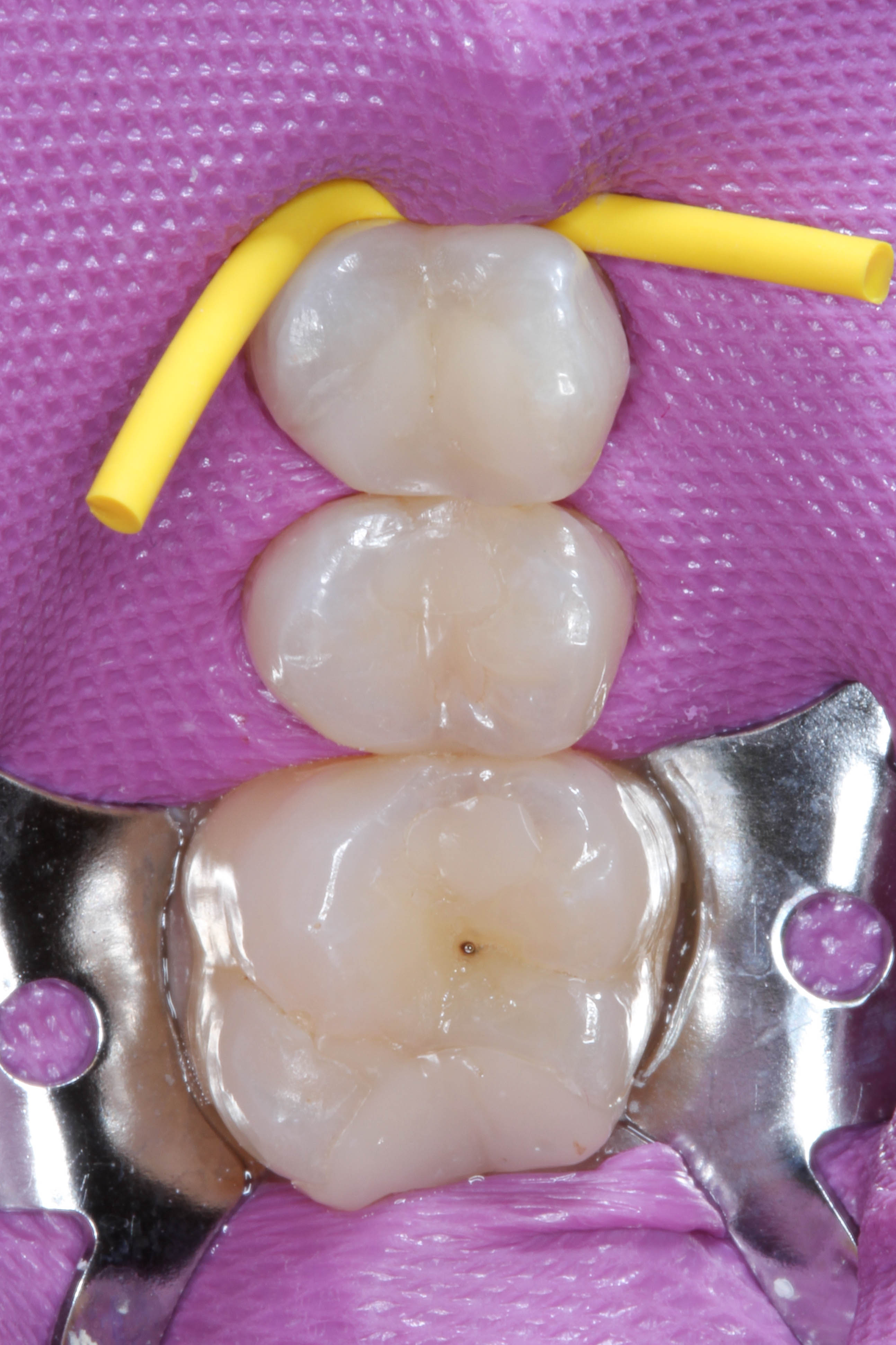 Teeth 15, 16, and 17