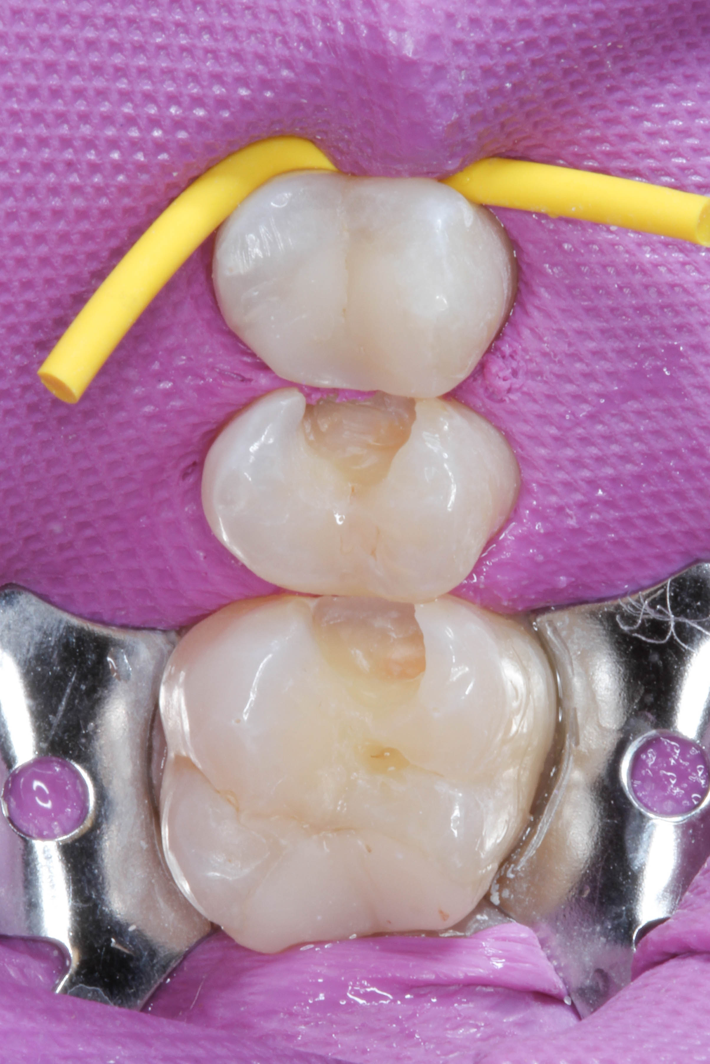 Teeth 15, 16, and 17
