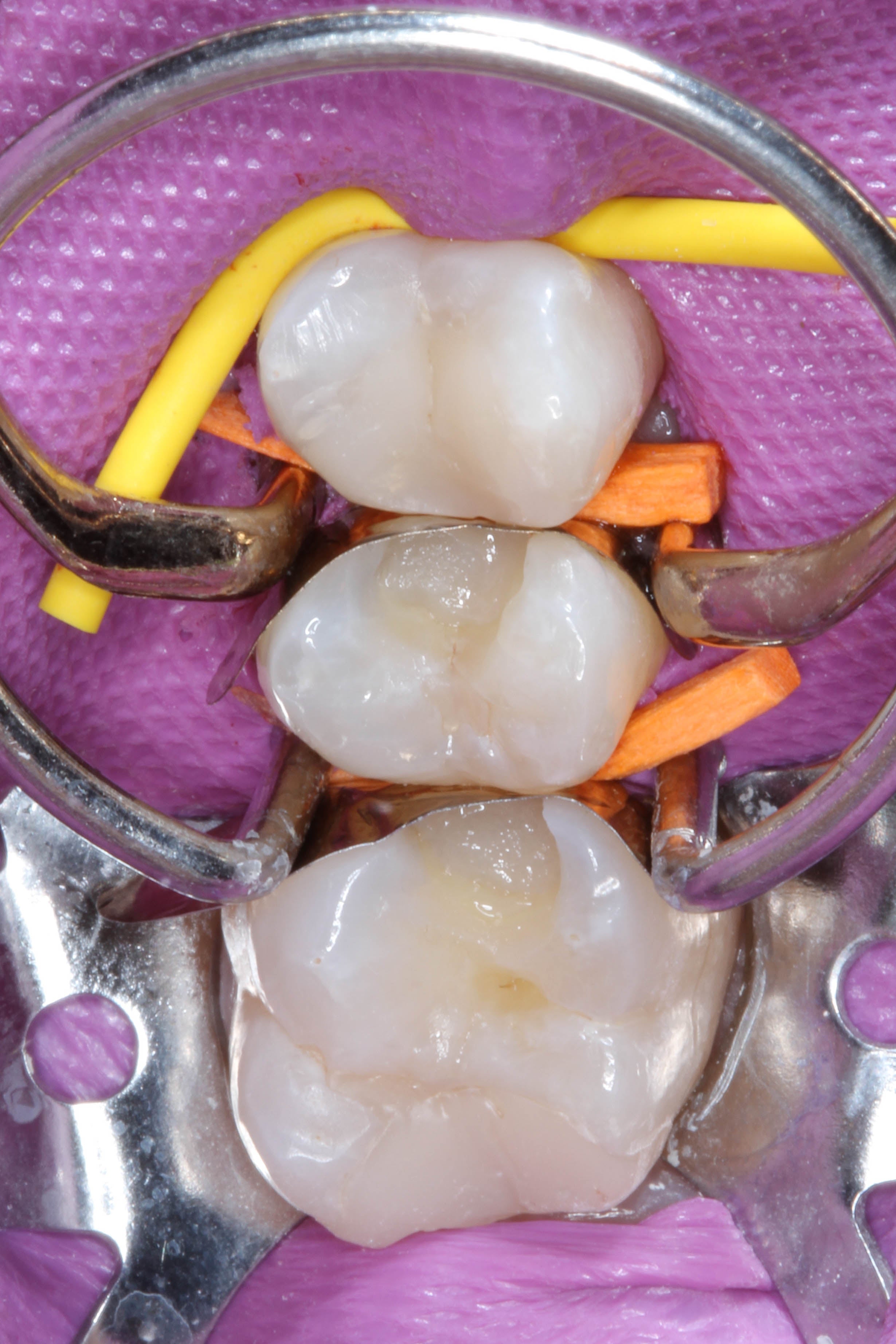 Teeth 15, 16, and 17