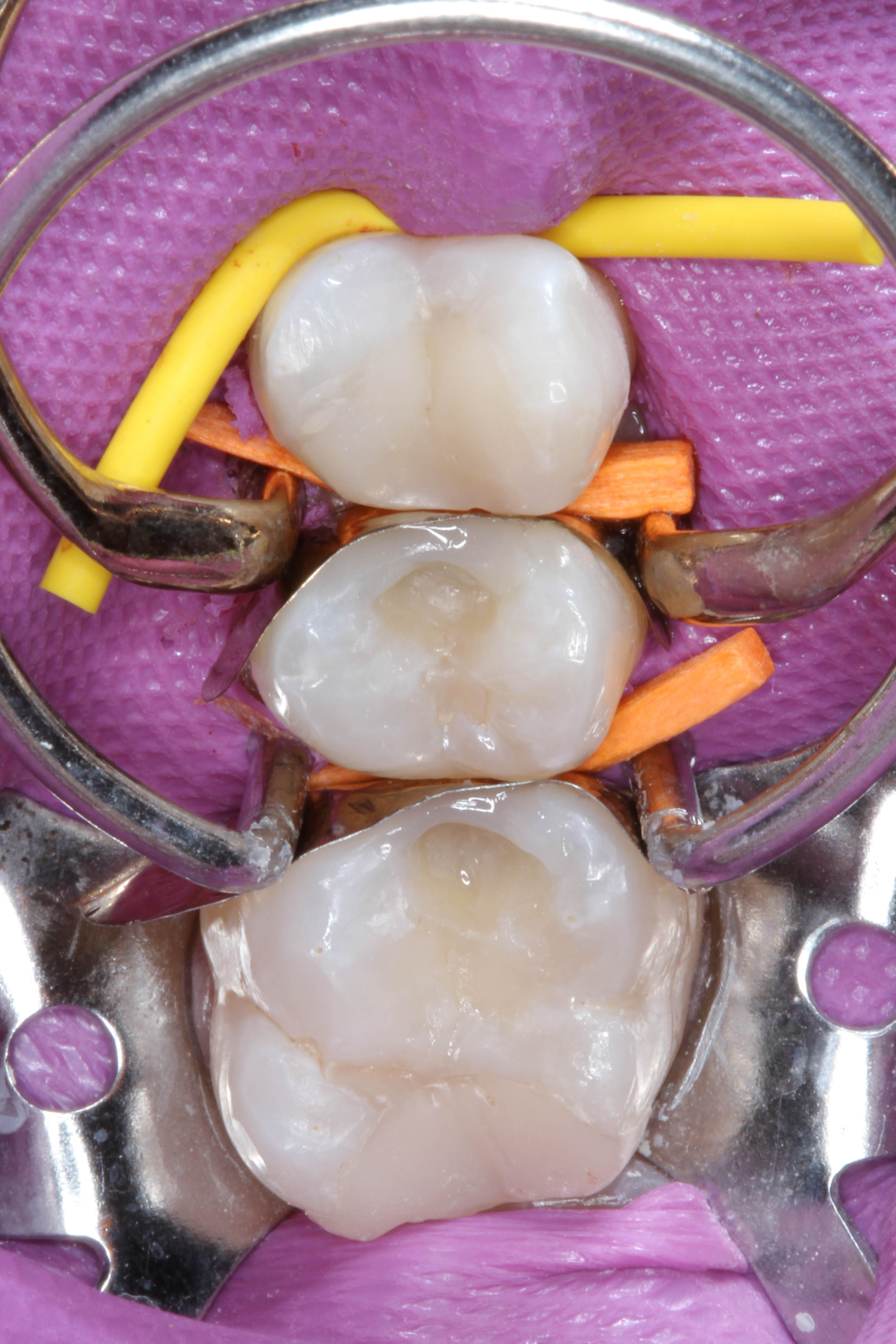 Teeth 15, 16, and 17