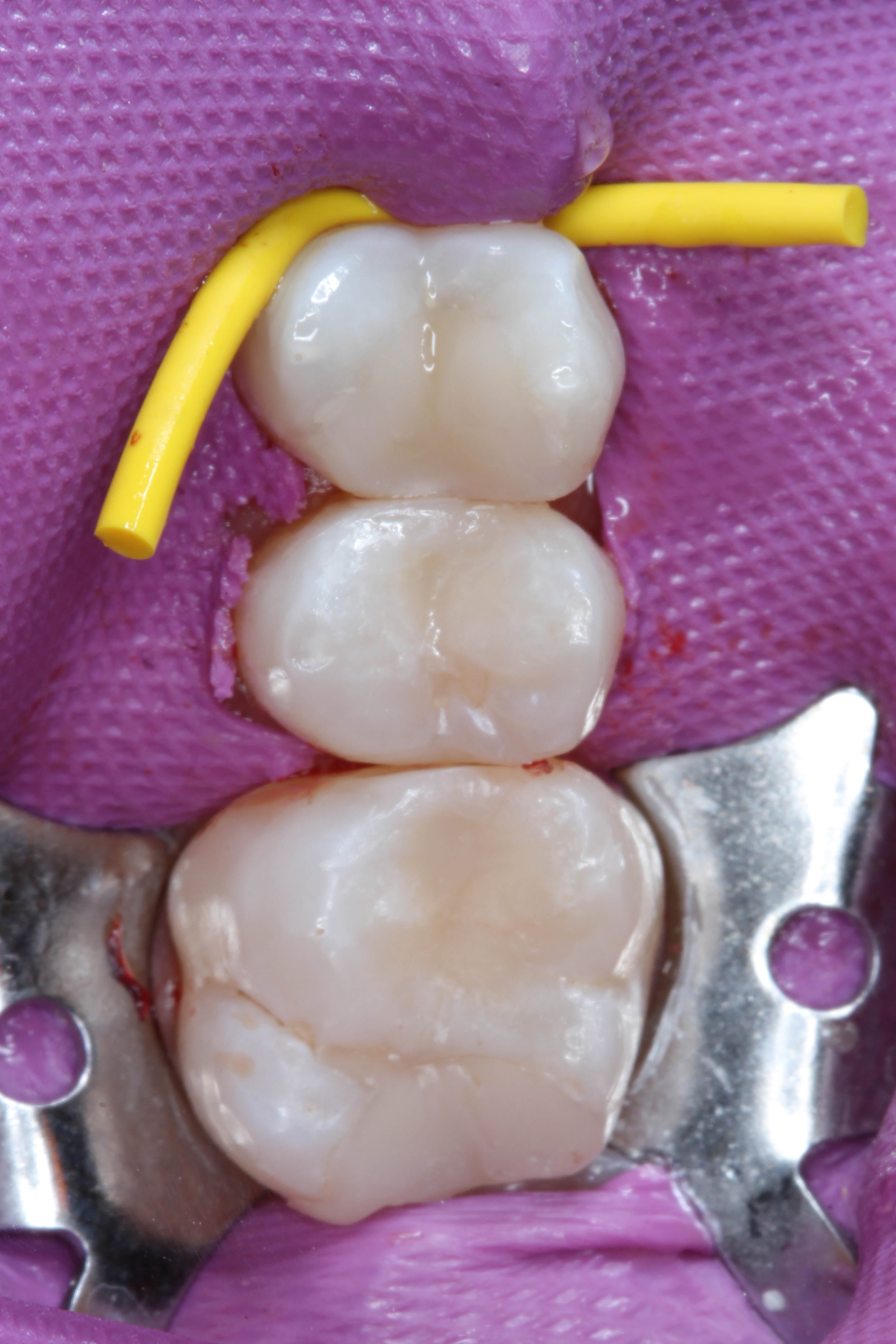Teeth 15, 16, and 17