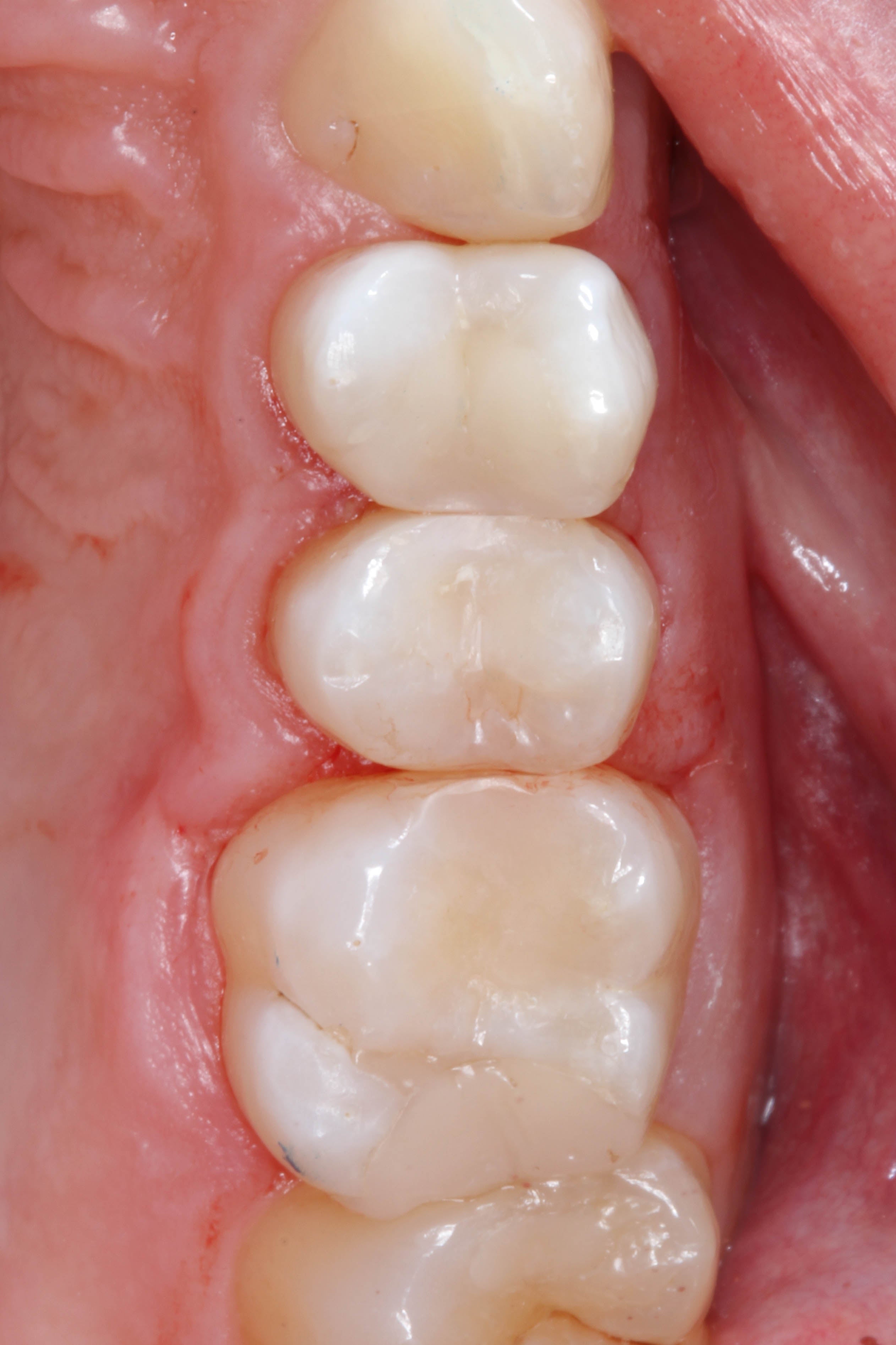 Teeth 15, 16, and 17