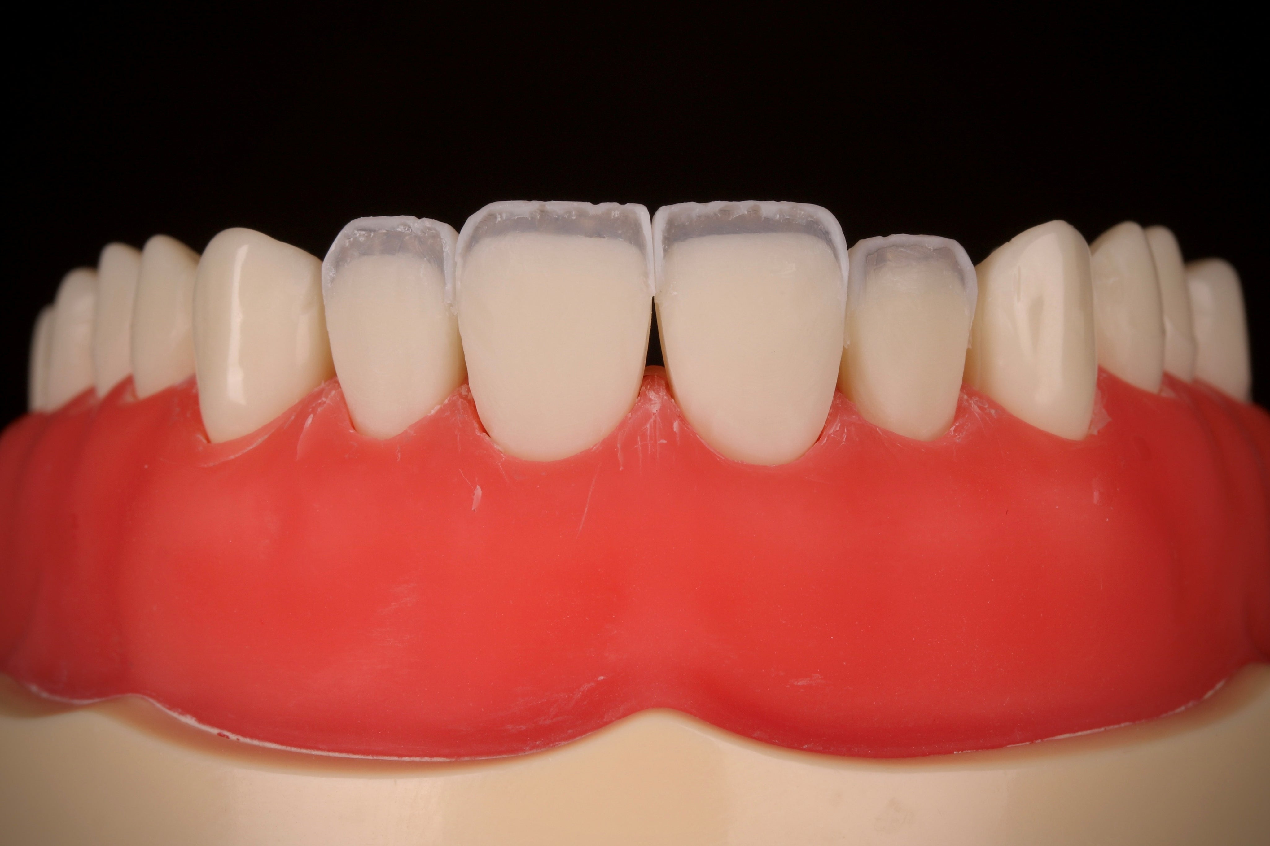direct-veneer-els-composite_2.jpg