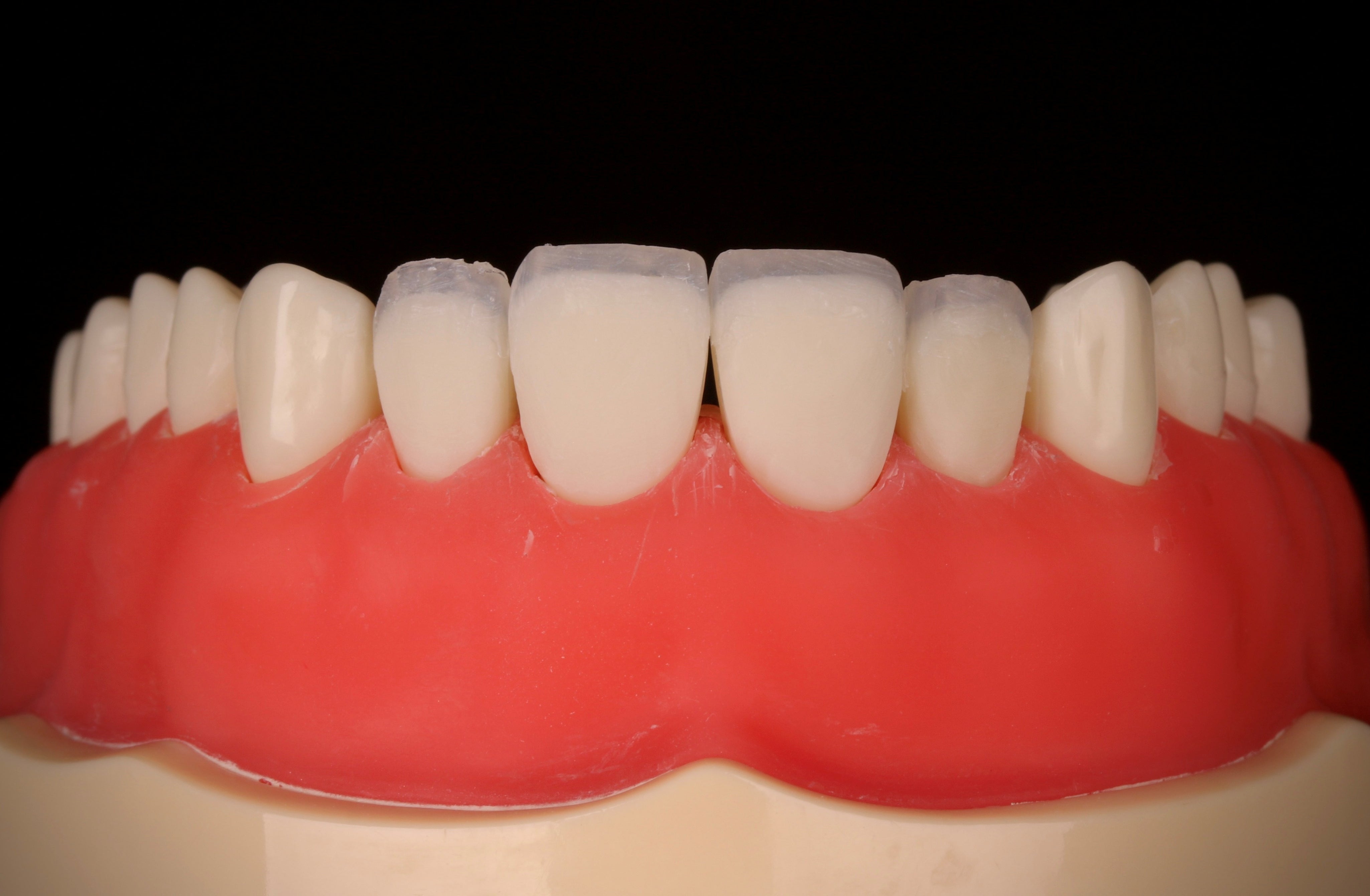 direct-veneer-els-composite_3.jpg