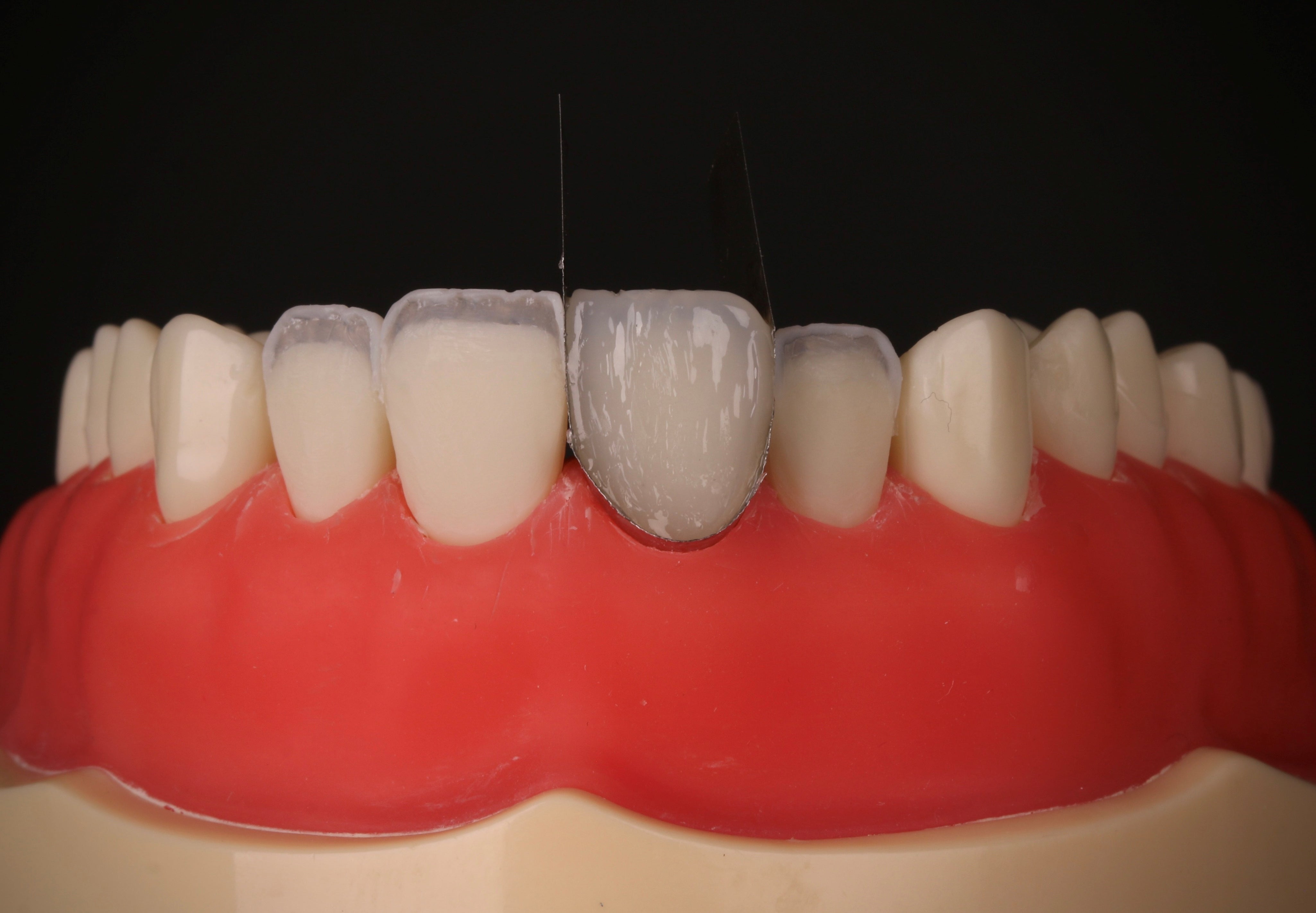 direct-veneer-els-composite_5.jpg