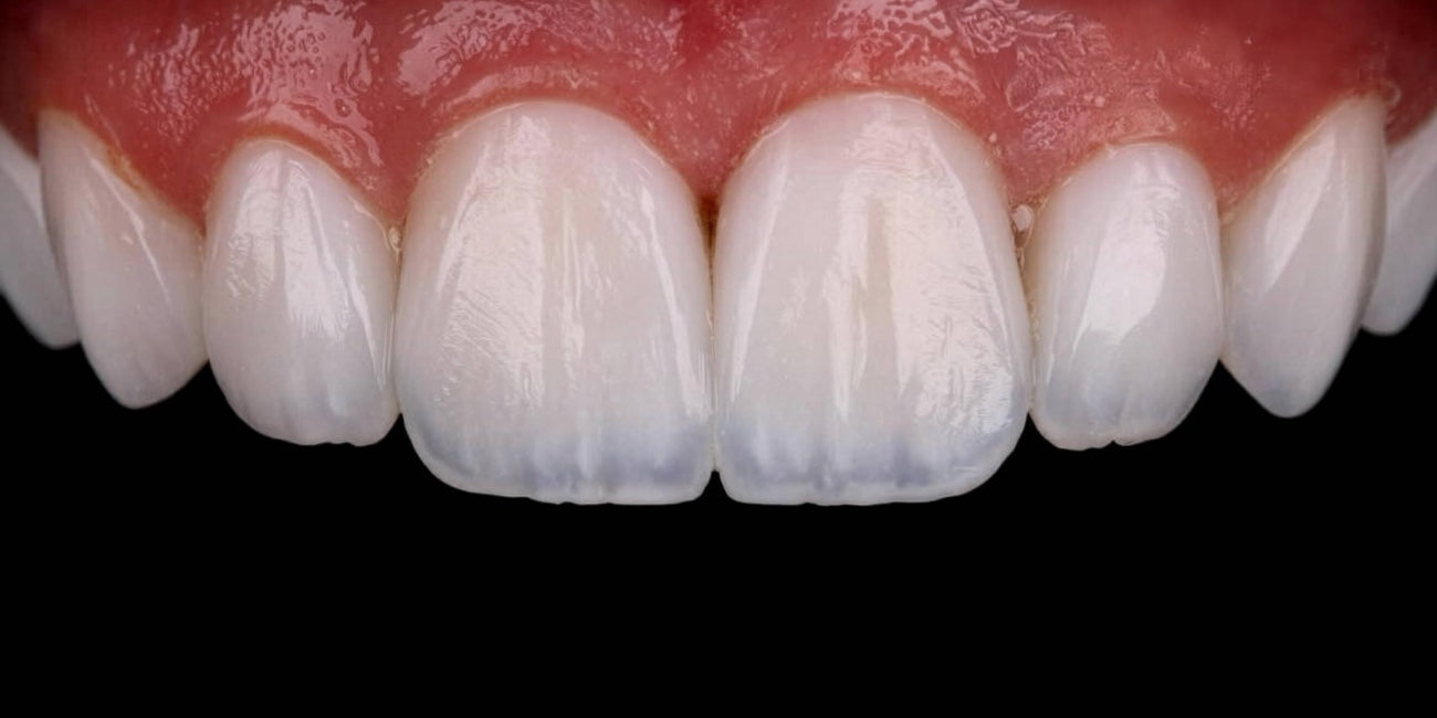 els_composite_direct_composite_veneers-5_4751fa35-200c-4a67-806a-ca3928a827ea.jpg